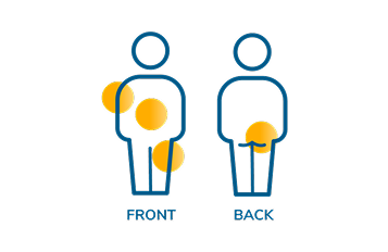 A silhouette of a person indicating areas for injection in the front and back of the body