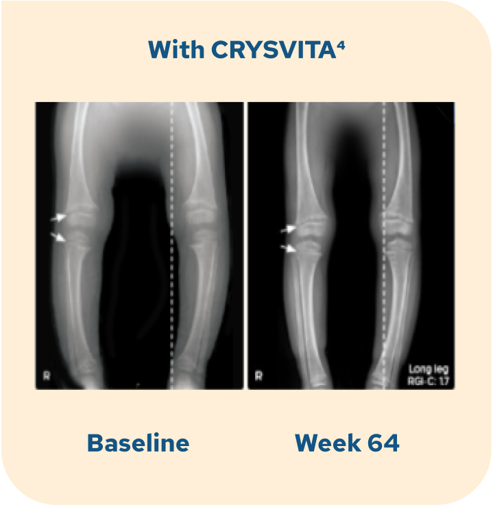 A set of X-ray images of a child's legs showing lower extremity abnormality improvement from baseline to week 64 with CRYSVITA