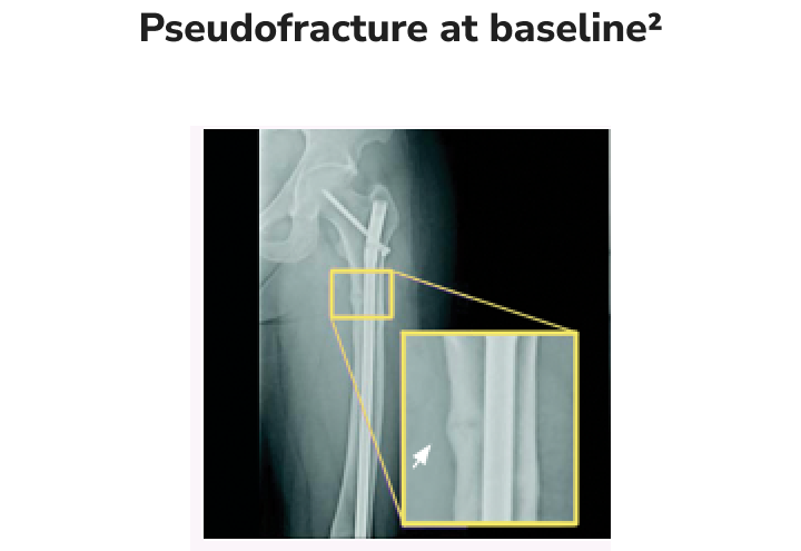 X-ray of a femur bone showing a pseudofracture at baseline