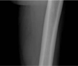 X-ray image of a normal femur