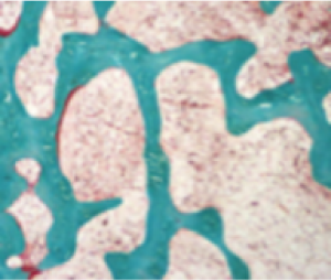 Micrographic image of normal bone; mineralized bone shown in green; unmineralized osteoid shown in orange or red