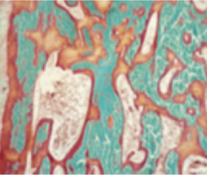 Micrographic image of a bone with osteomalacia; mineralized bone shown in green; unmineralized osteoid shown in orange or red