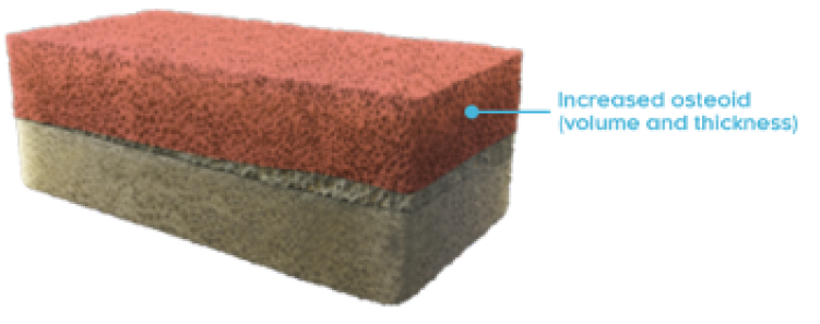 Rectangular cross-section of a bone with osteomalacia with increased osteoid (volume and thickness) labeled