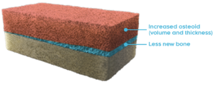 Rectangular cross-section of a bone with osteomalacia with increased osteoid (volume and thickness) and less new bone labeled