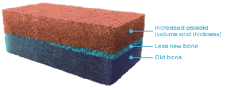 Rectangular cross-section of a bone with osteomalacia with increased osteoid (volume and thickness), less new bone, and old bone labeled
