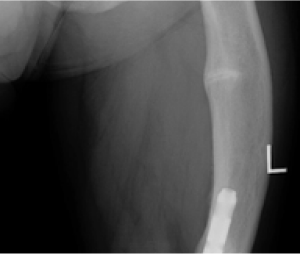 X-ray image of a femur with pseudofracture