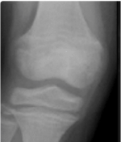 Knee x-ray representing RSS score of 1.0