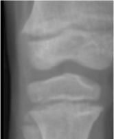 Knee x-ray representing RSS score of 2.0