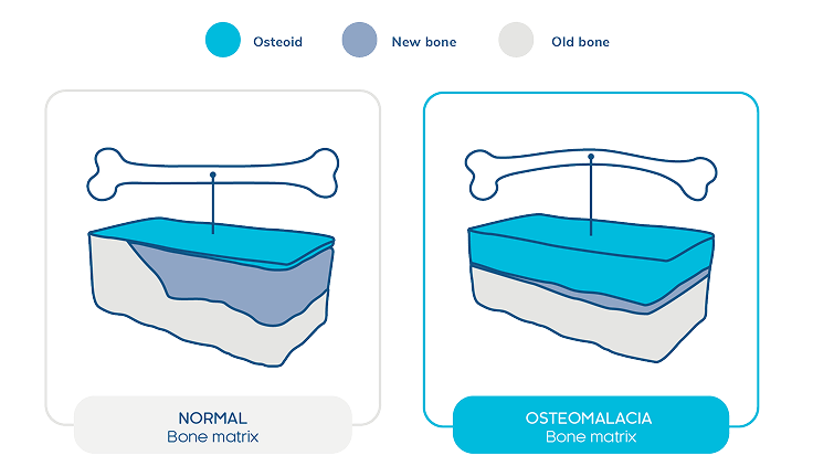 Illustration comparing normal bone matrix and osteomalacia bone matrix. The normal bone matrix shows layers labeled osteoid, new bone, and old bone with a thinner osteoid layer. The osteomalacia bone matrix shows the same labeled layers with a thicker osteoid layer