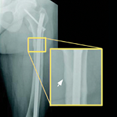 Radiograph of healed pseudofractures at week 24 with a highlighted inset of the same area