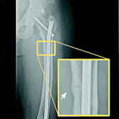 Radiograph of a pseudofracture at baseline with a highlighted inset showing the fracture site