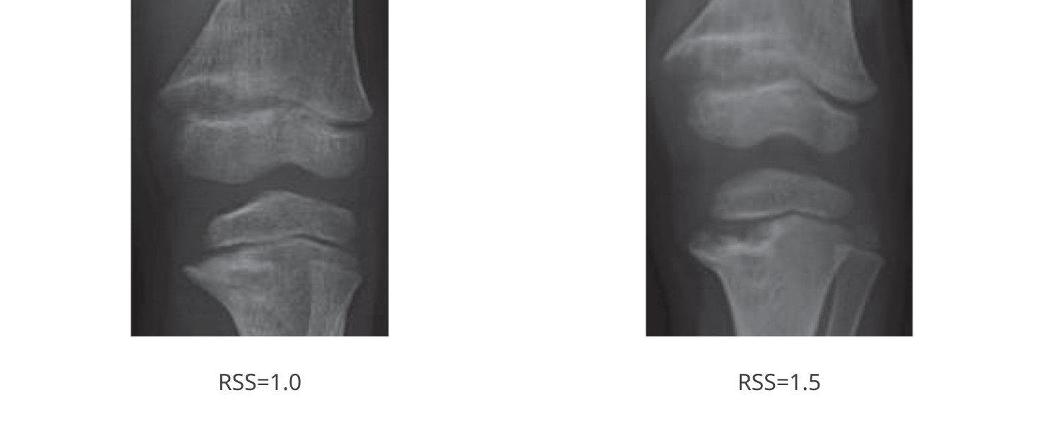 Knee x-ray image example labeled RSS 1.0 on the Thacher Rickets Severity Score scale; Knee x-ray image example labeled RSS 1.5 on the Thacher Rickets Severity Score scale