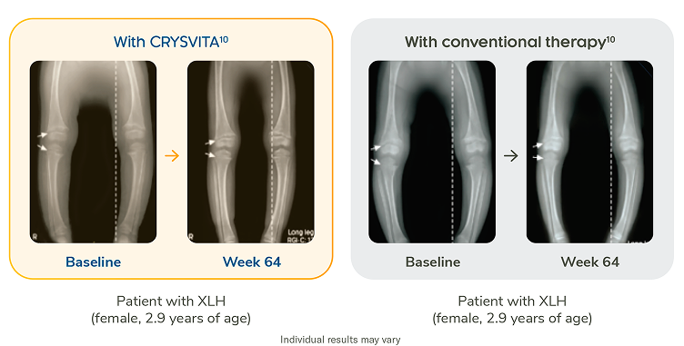 X-ray images showing lower legs at baseline and at week 64 with CRYSVITA treatment;X-ray images showing lower legs at baseline and at week 64 with conventional therapy
