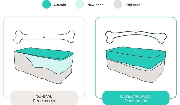 Cross-sectional illustration of normal bone matrix showing a thin osteoid layer over mineralized bone, Cross-sectional illustration of osteomalacia bone matrix showing a thickened osteoid layer over reduced mineralized bone