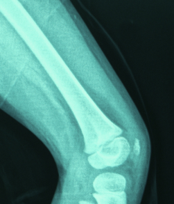 X-ray image of femur and knee bones representing how CRYSVITA healed bone abnormalities