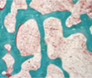 Micrographic image of normal bone; mineralized bone shown in green; unmineralized osteoid shown in orange or red