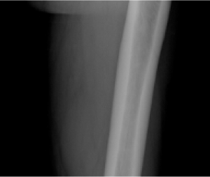 X-ray image of a normal femur