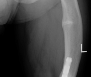 X-ray image of a femur with pseudofracture